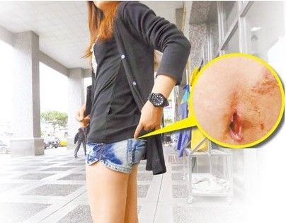 女<em>臀部</em>拔玻璃,留体内10月 图